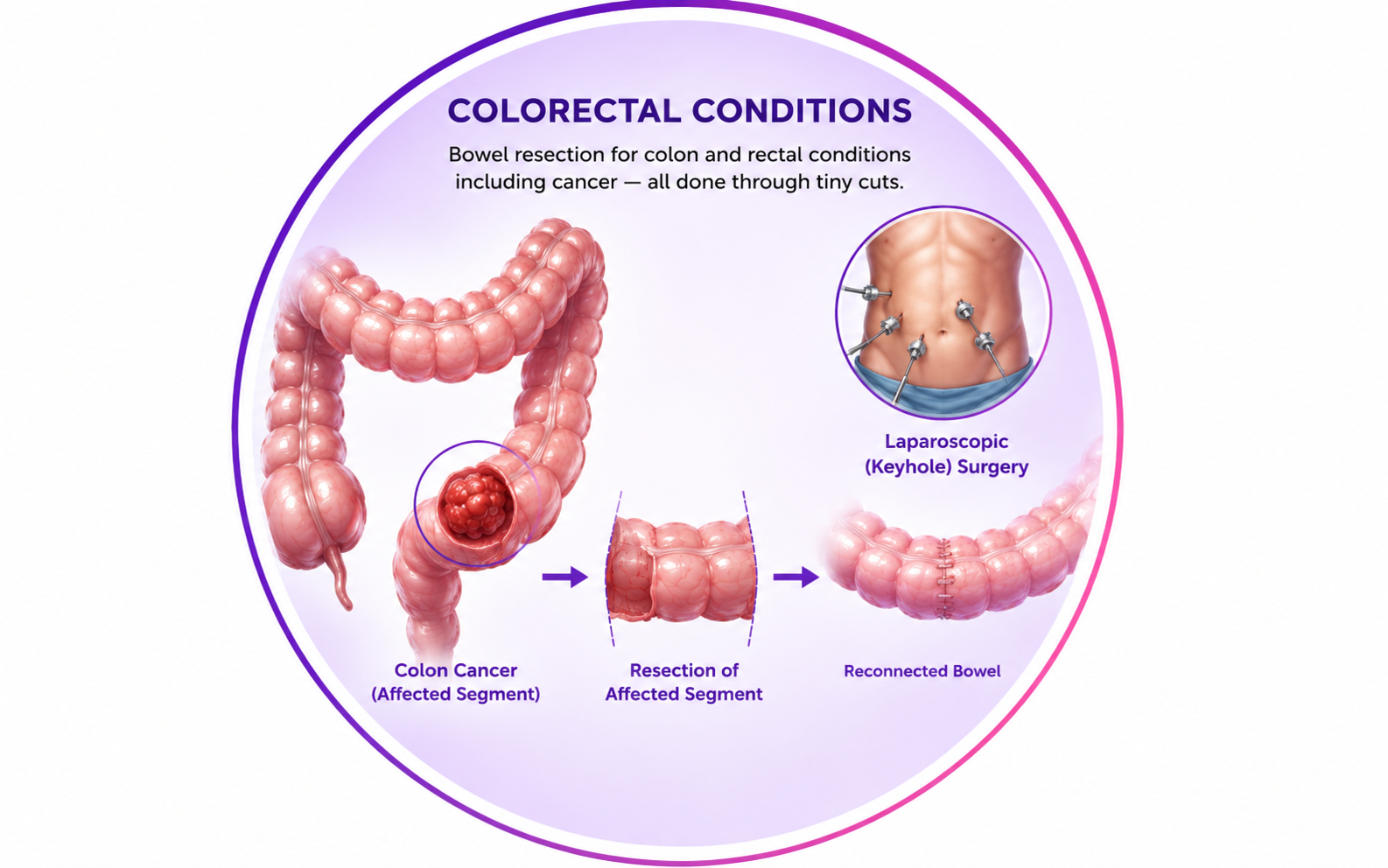 Colorectal