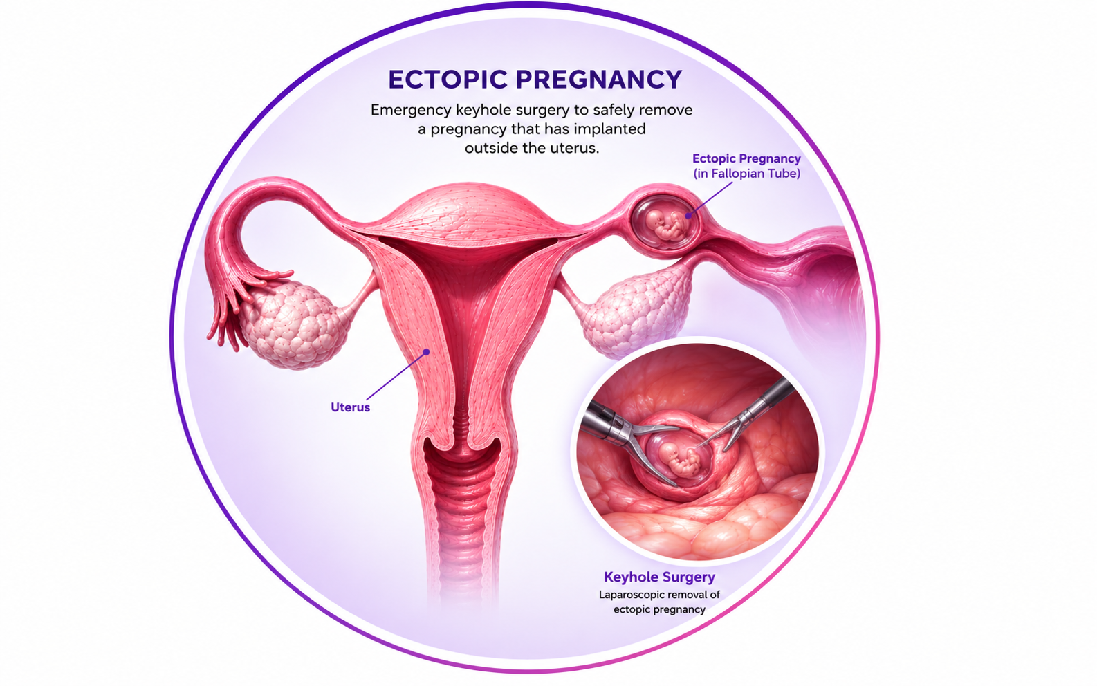 Ectopic Pregnancy