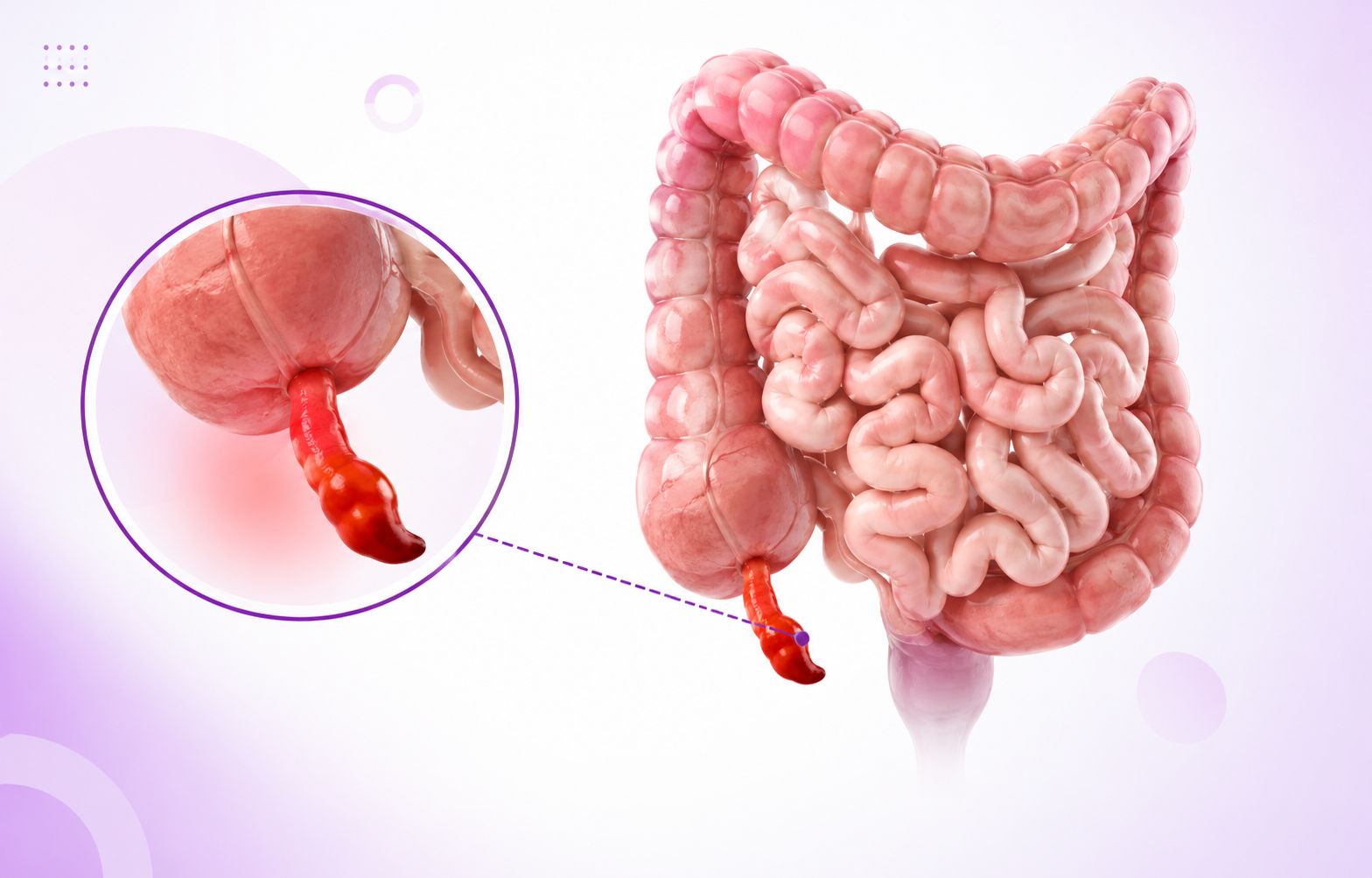 Appendicitis