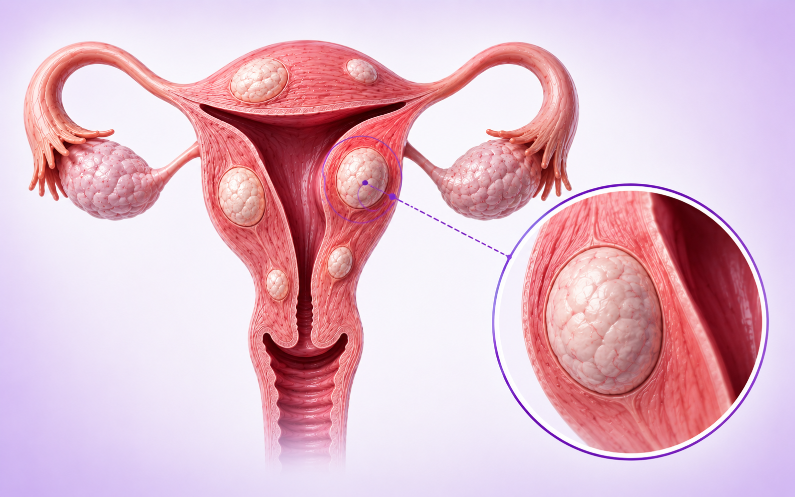 Uterine Fibroids