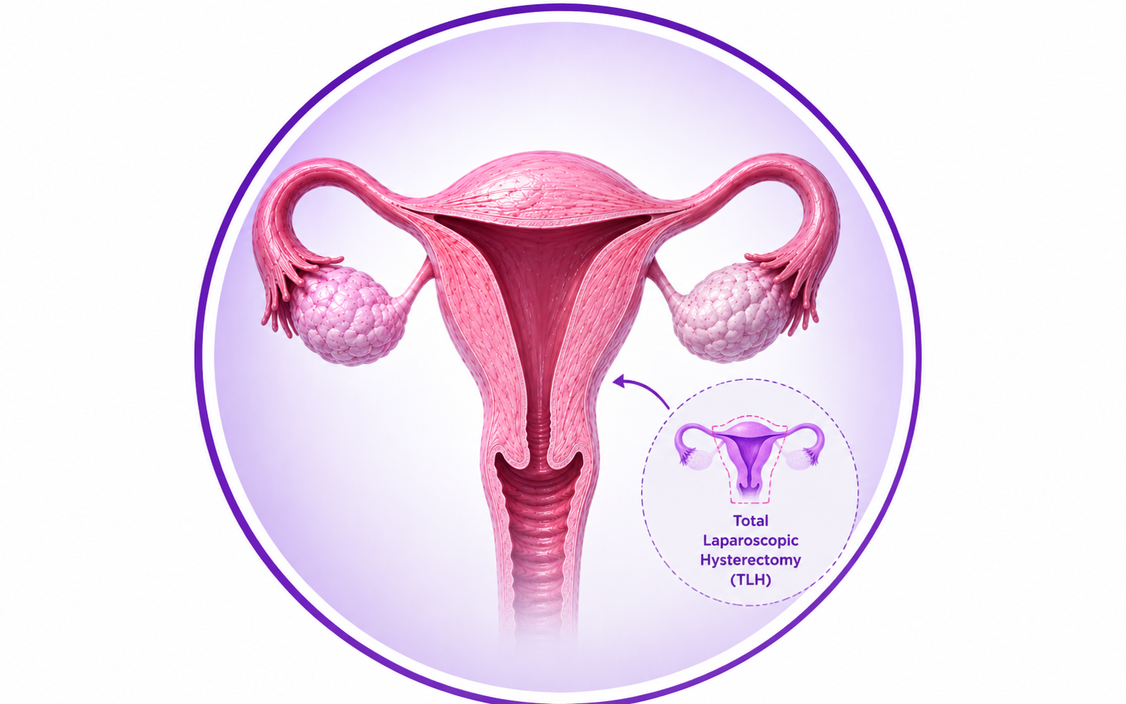 Hysterectomy