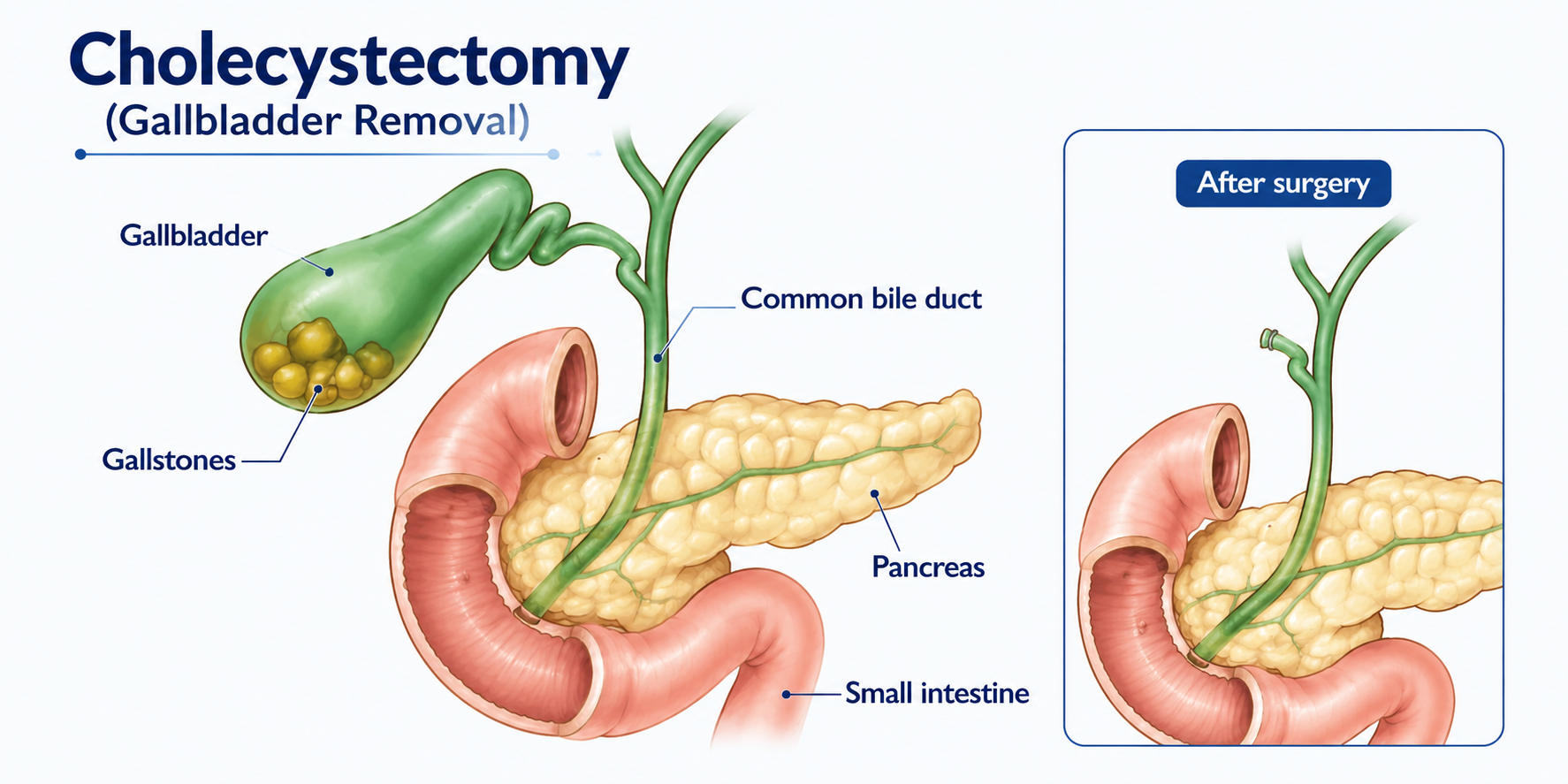 Cholecystectomy