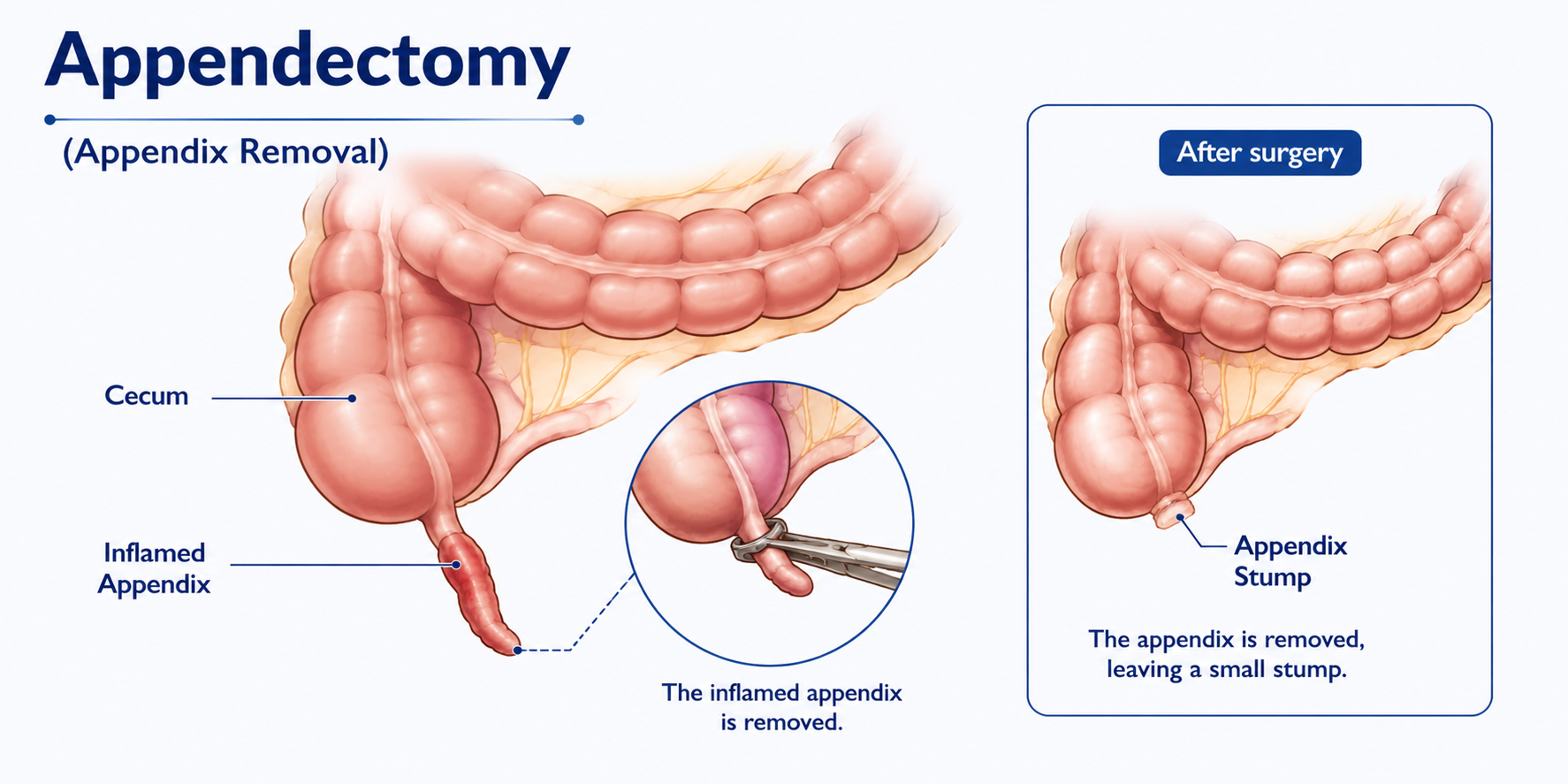 Appendectomy