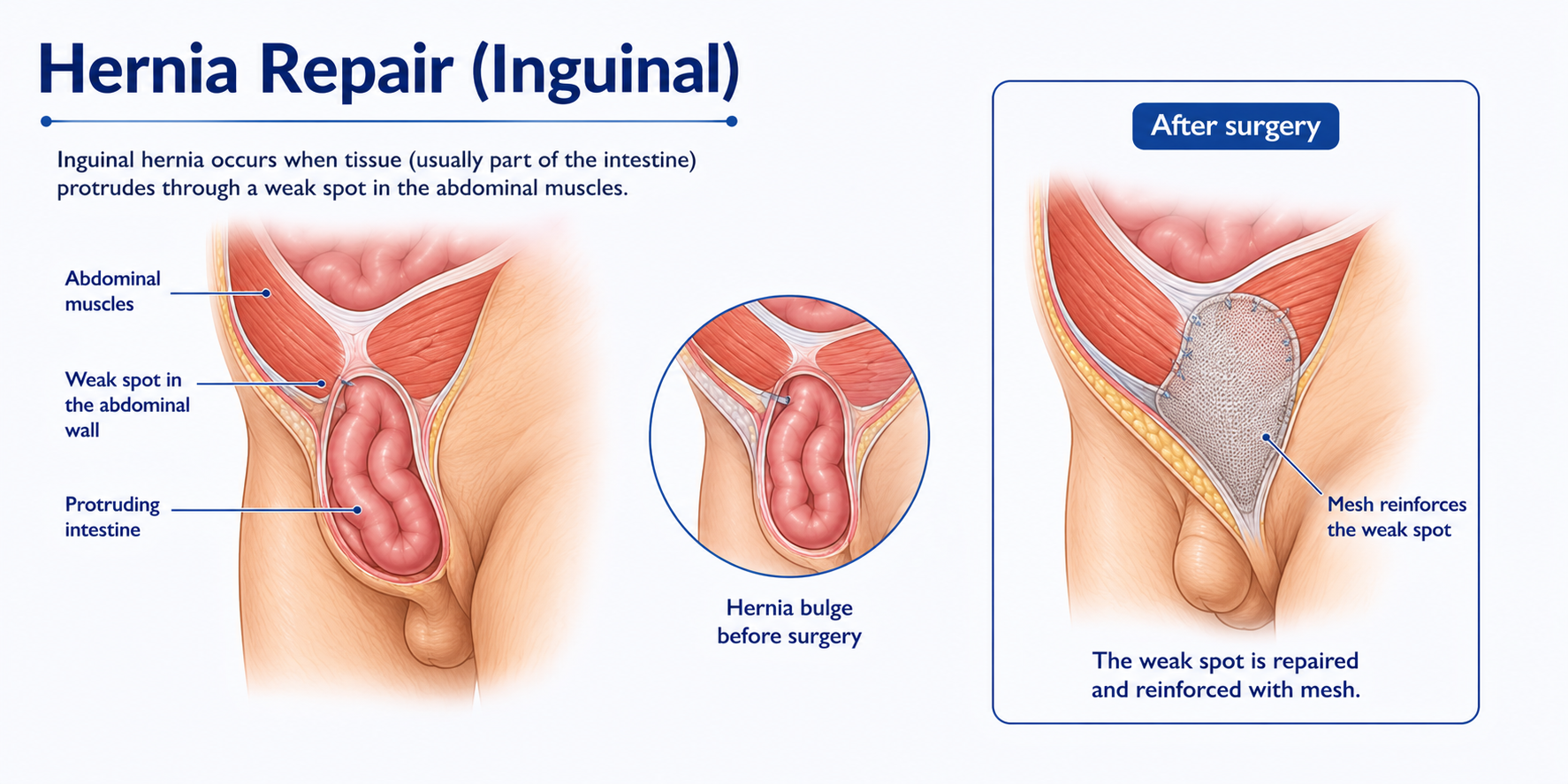 Hernia Inguinal