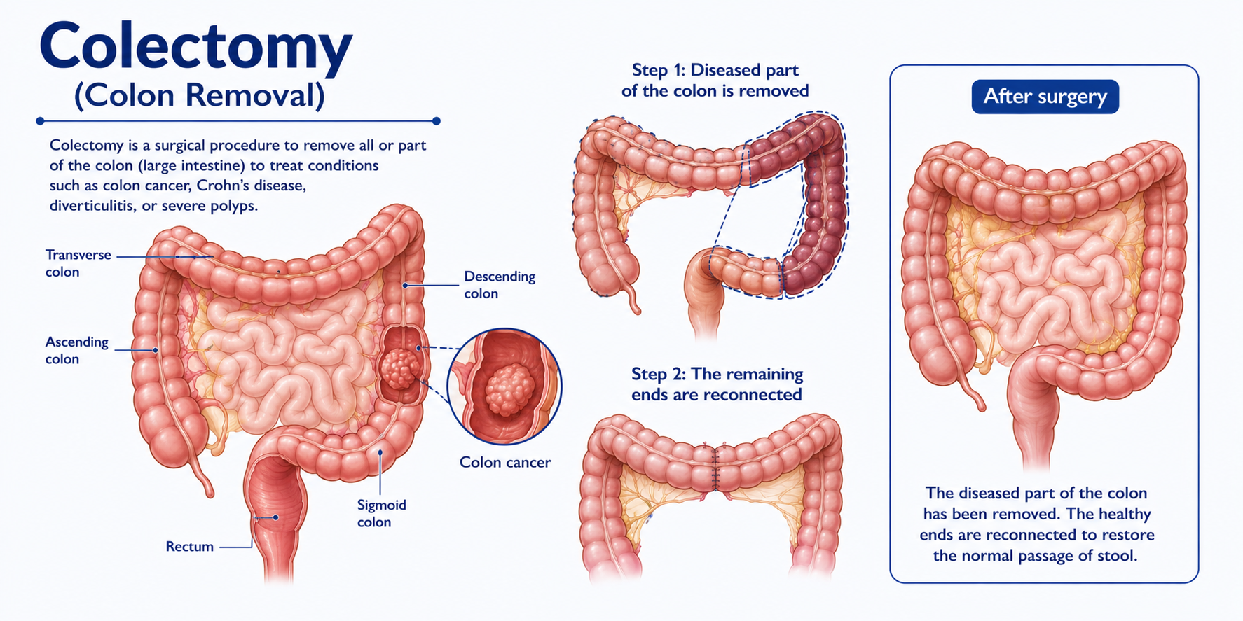 Colectomy