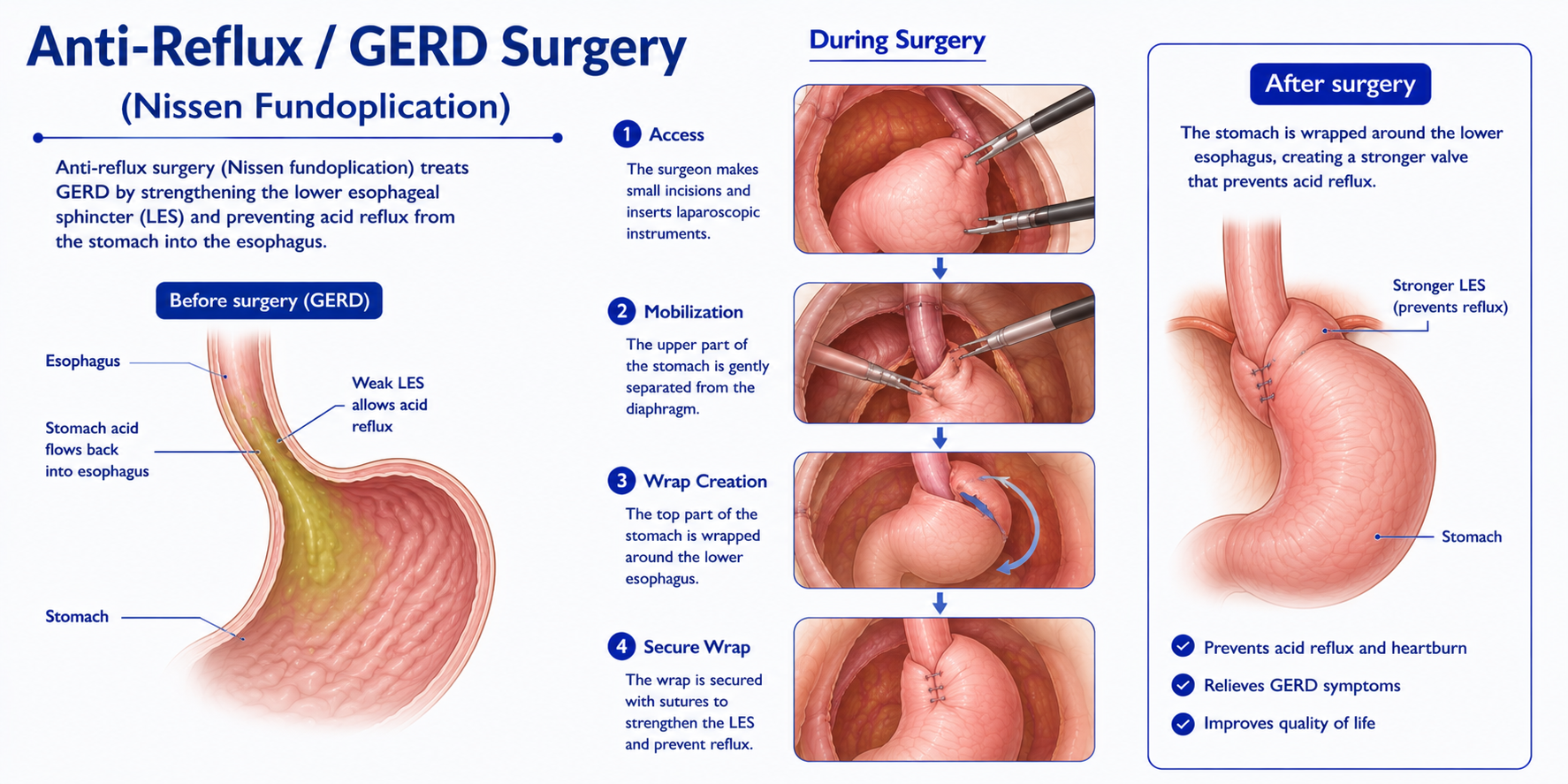 Anti-Reflux GERD