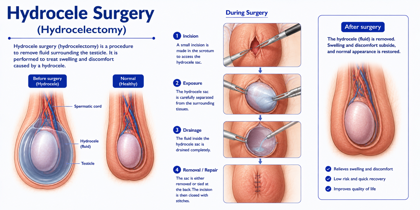 Hydrocele Surgery