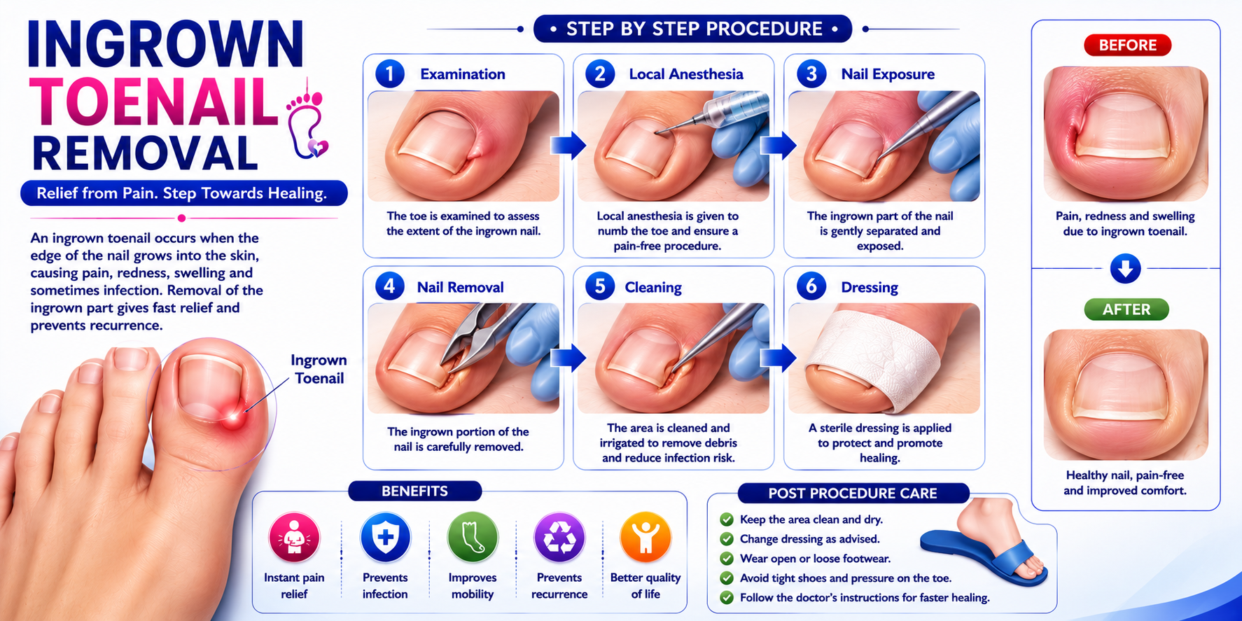 Ingrown Toenail Removal