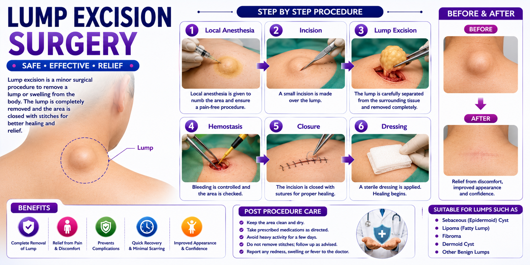 Lump Excision Surgery