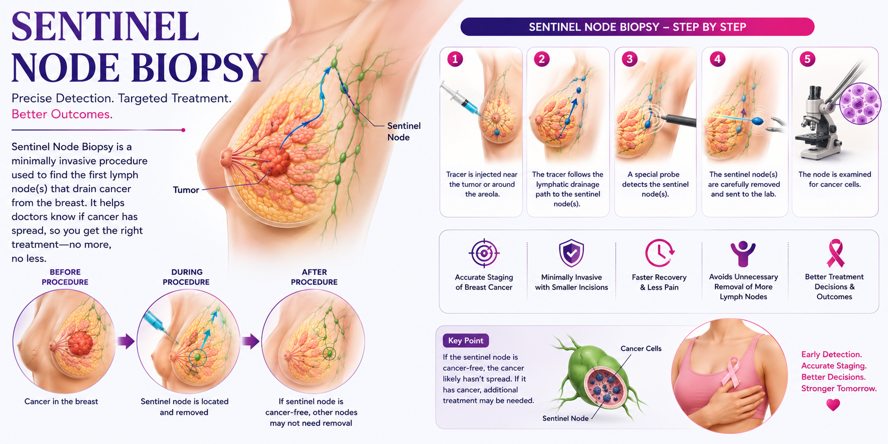 Sentinel Node Biopsy