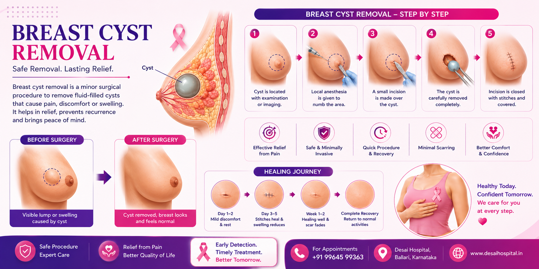 Breast Cyst Removal