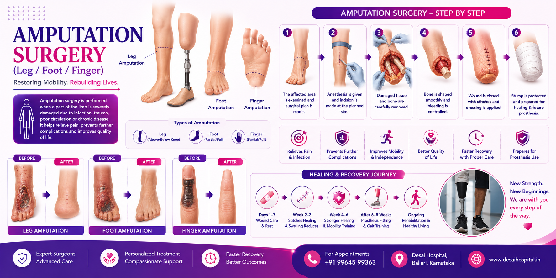 Amputation Surgery