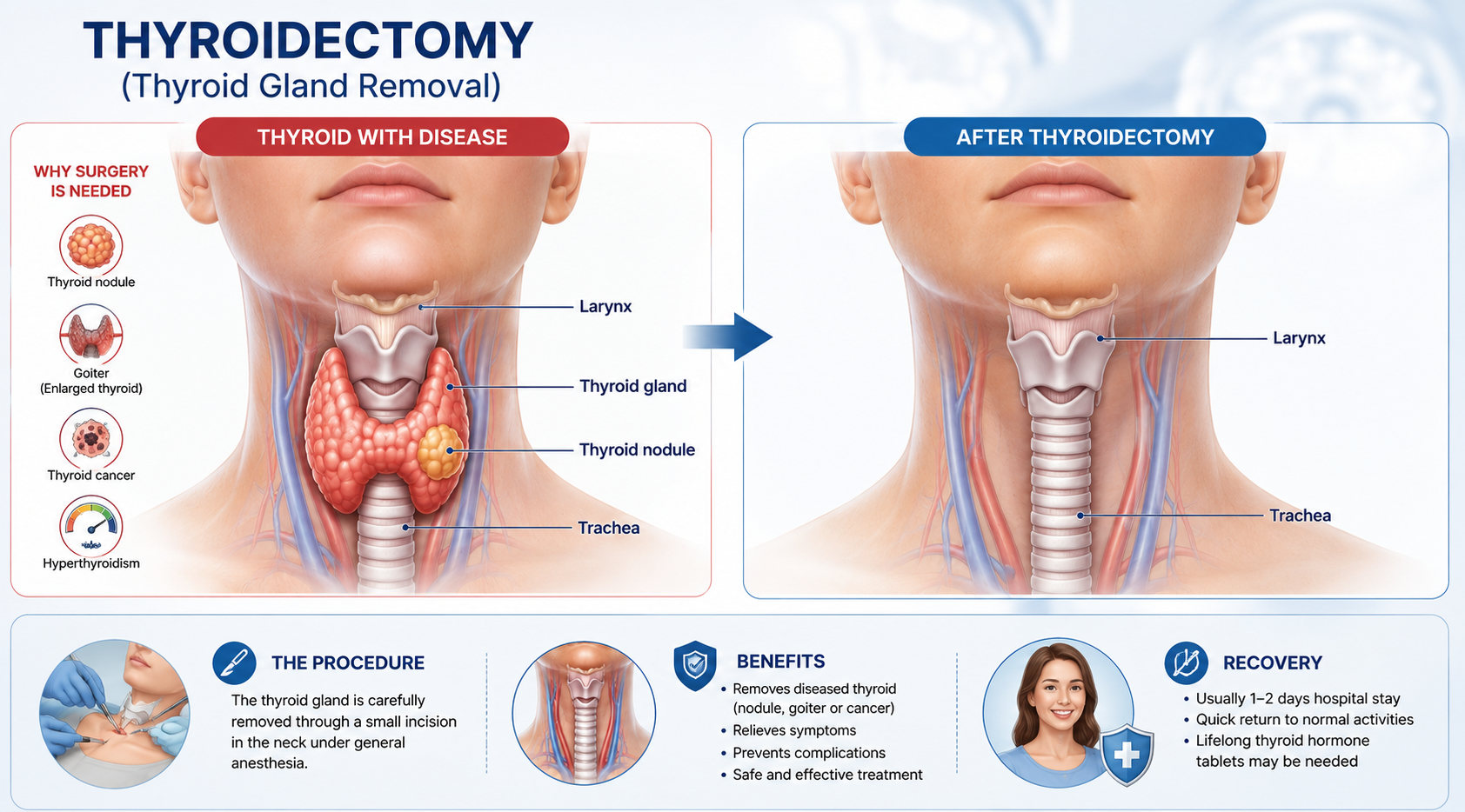 Thyroidectomy