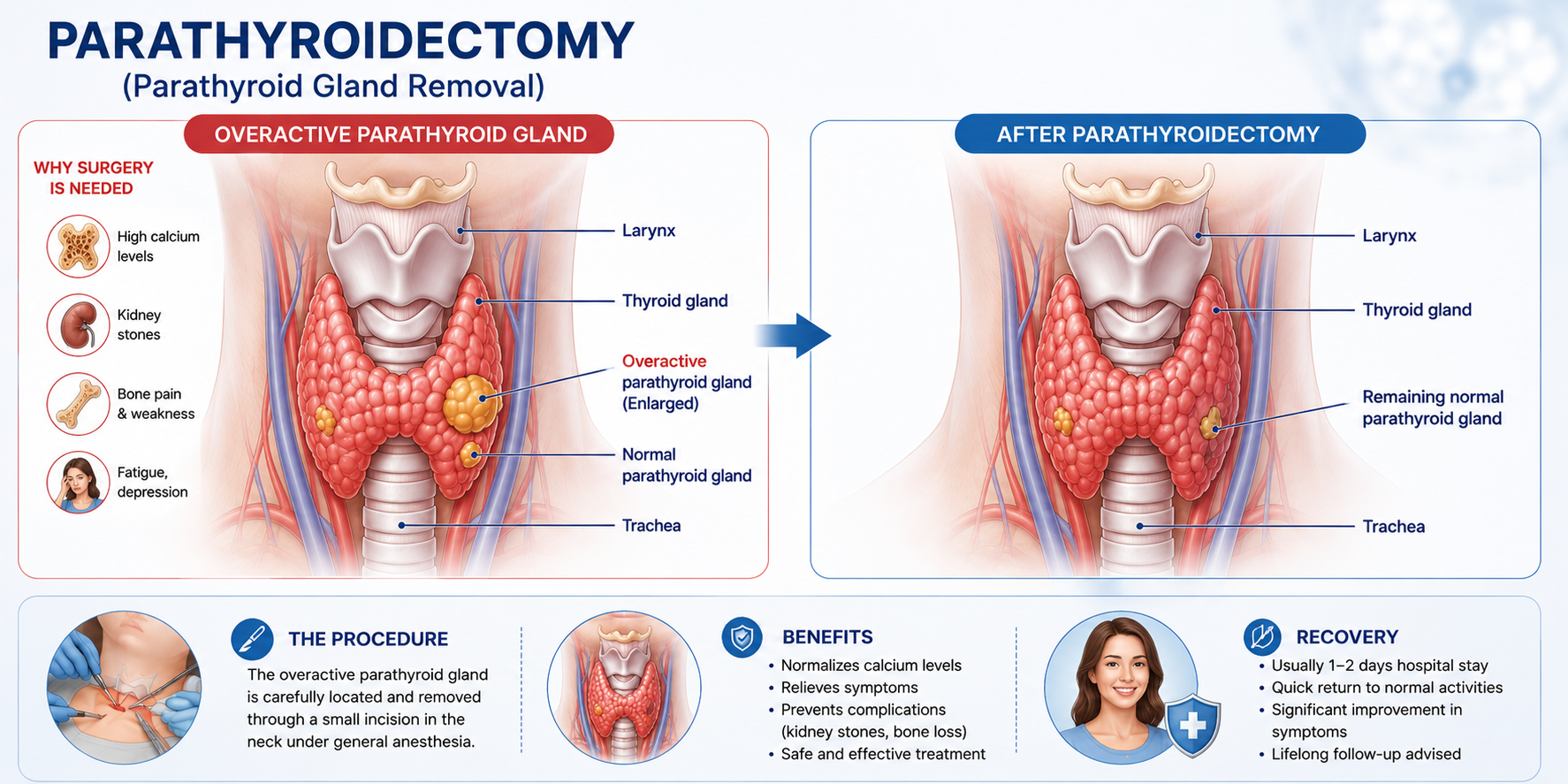 Parathyroidectomy