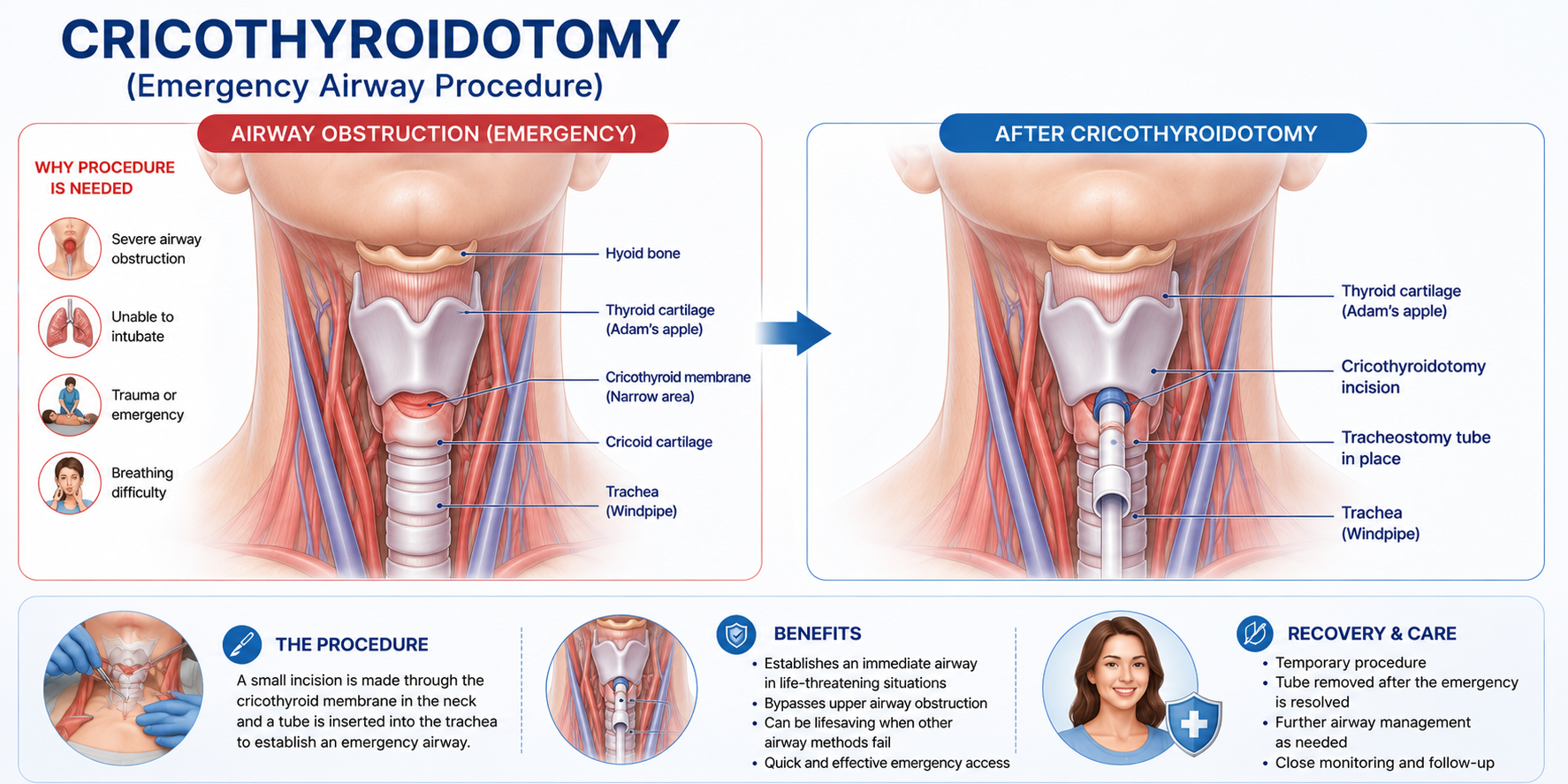 Cricothyroidotomy