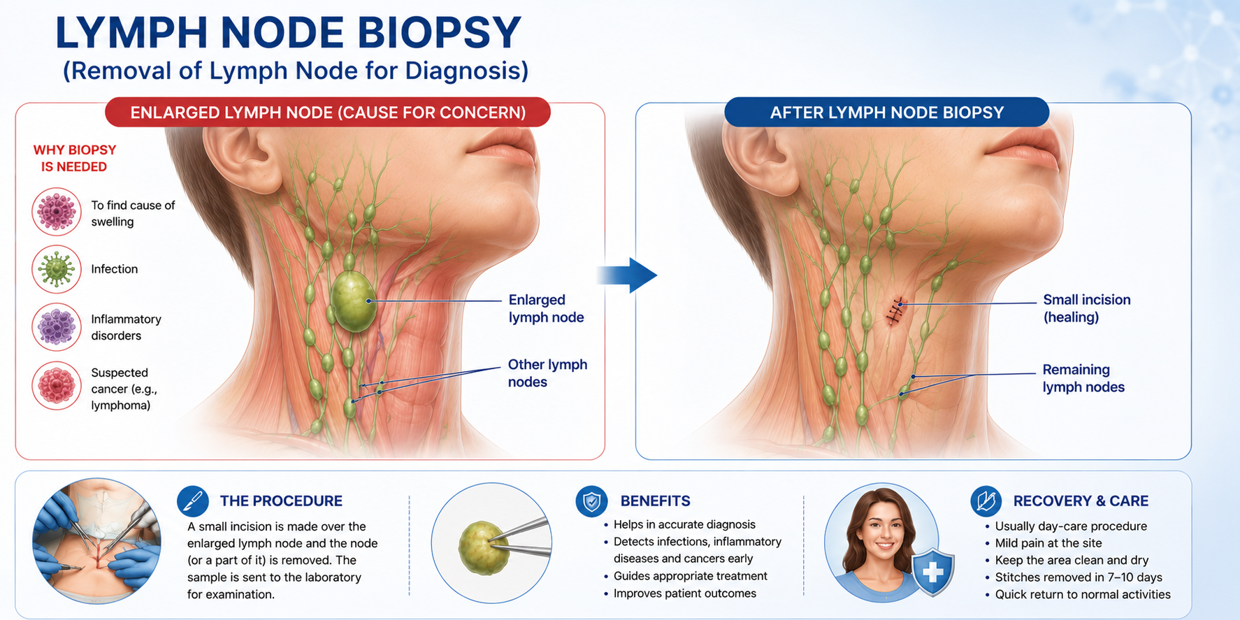 Lymph Node Biopsy