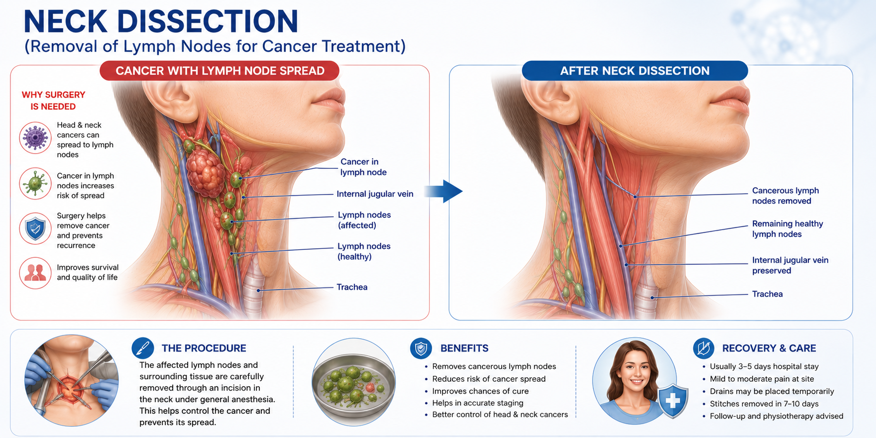 Neck Dissection