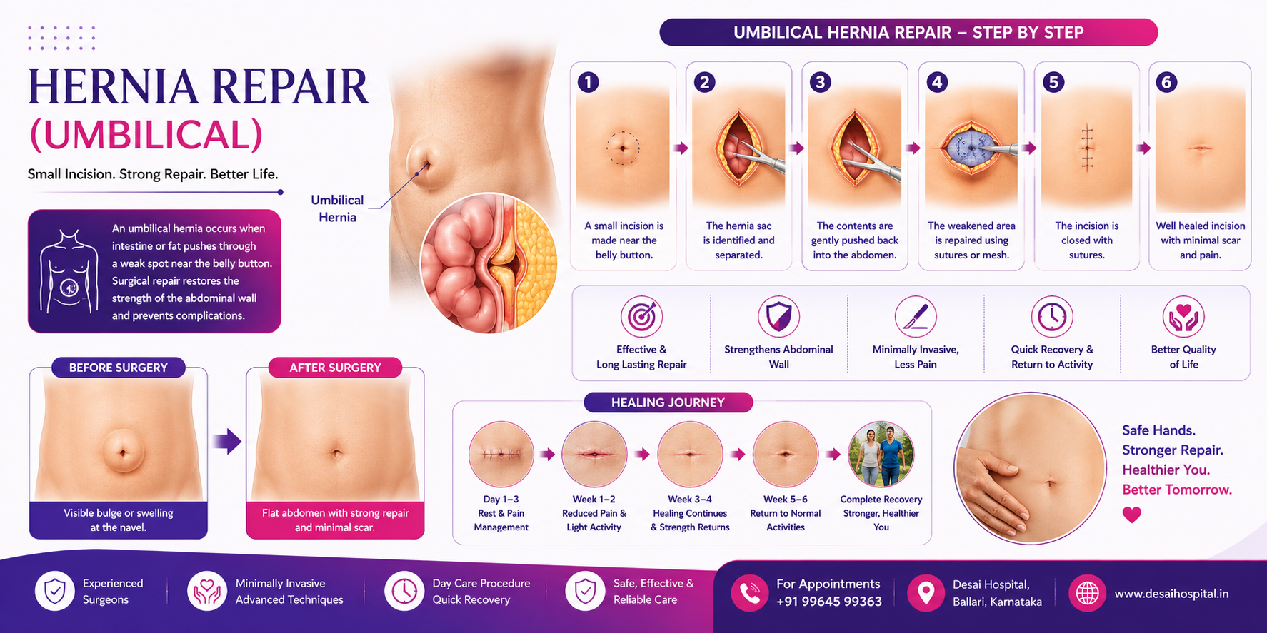 Hernia Umbilical