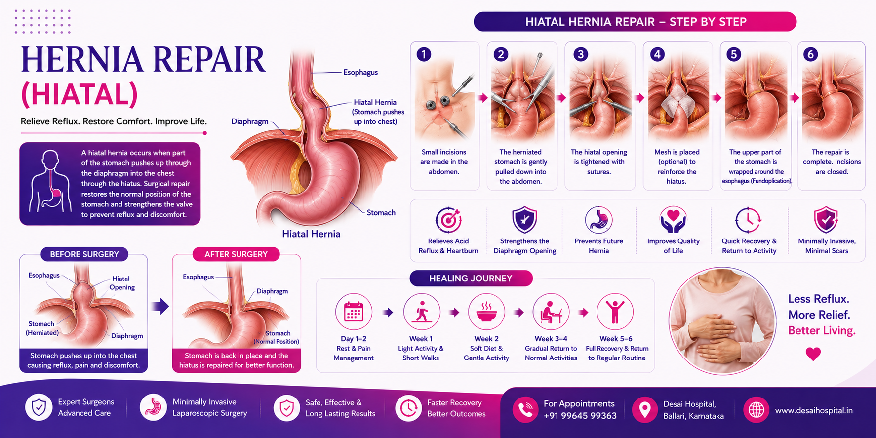 Hernia Hiatal