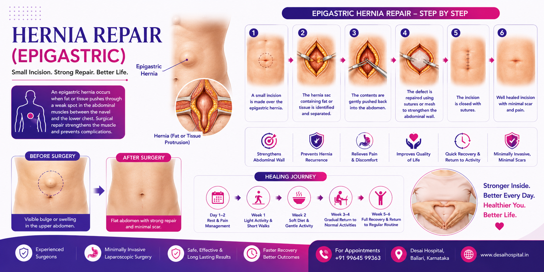 Hernia Epigastric