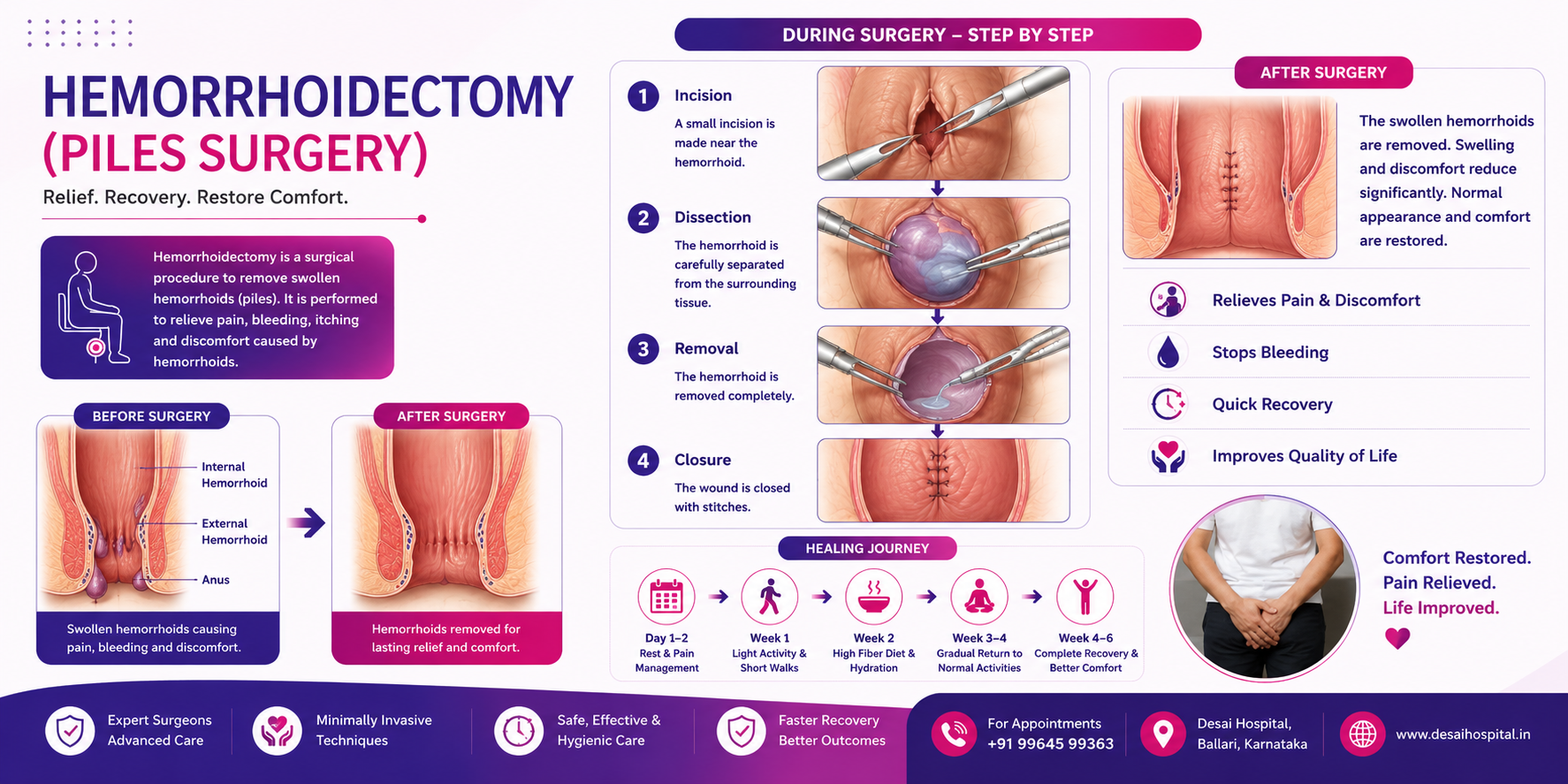 Hemorrhoidectomy