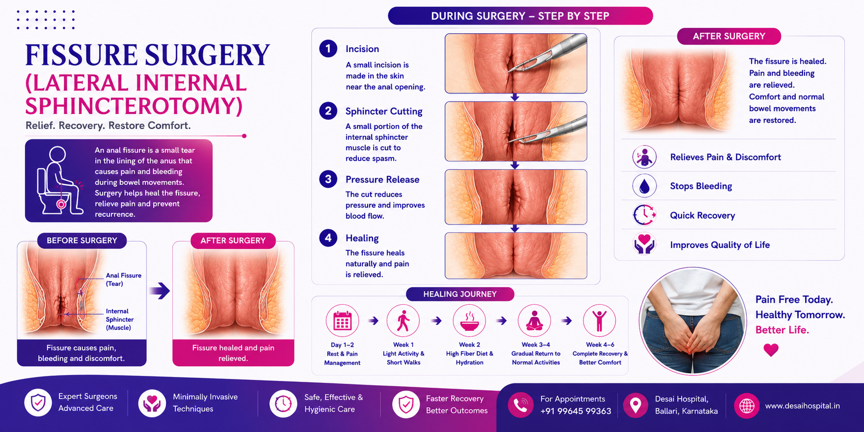 Fissure Surgery