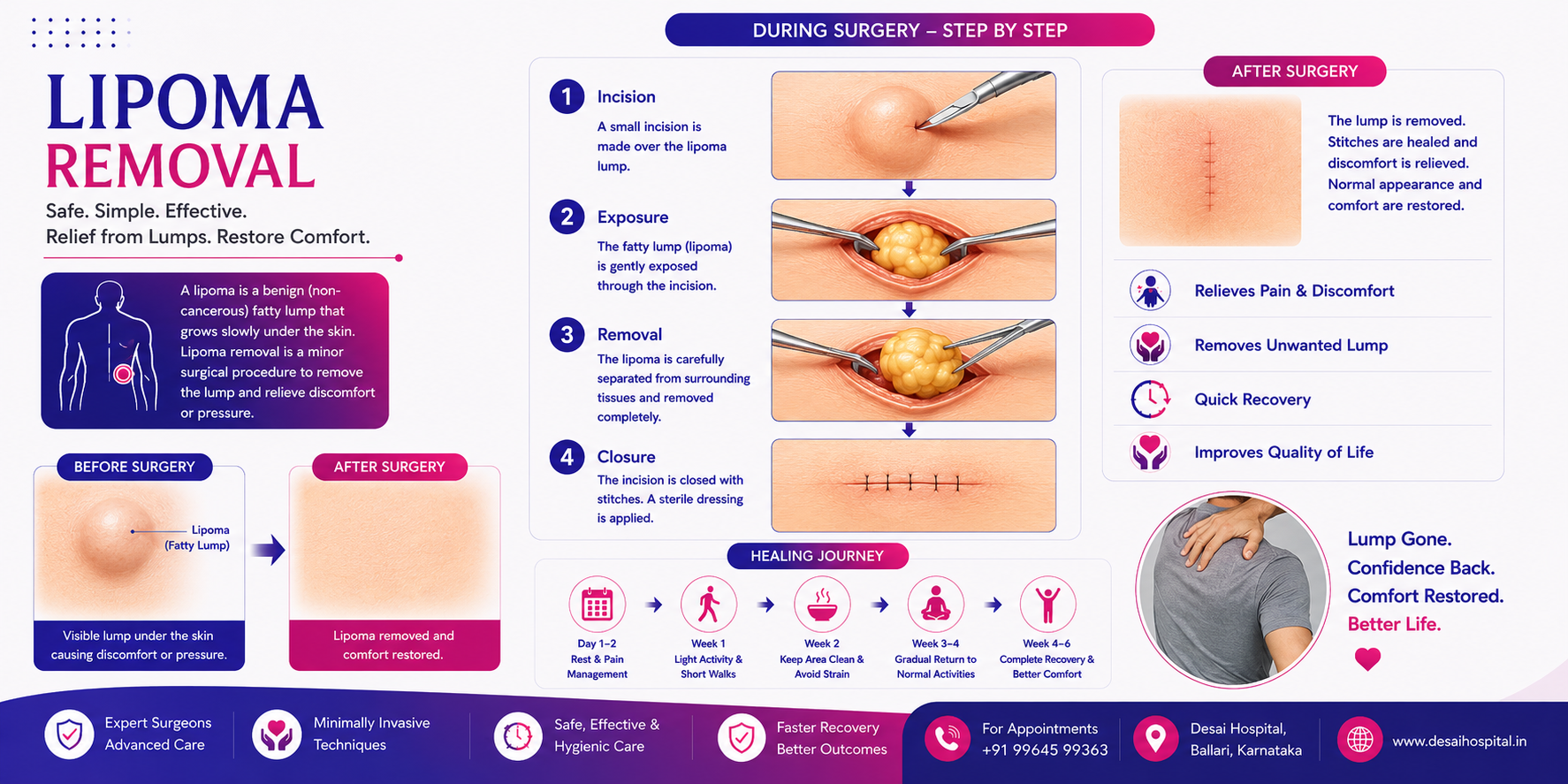 Lipoma Removal