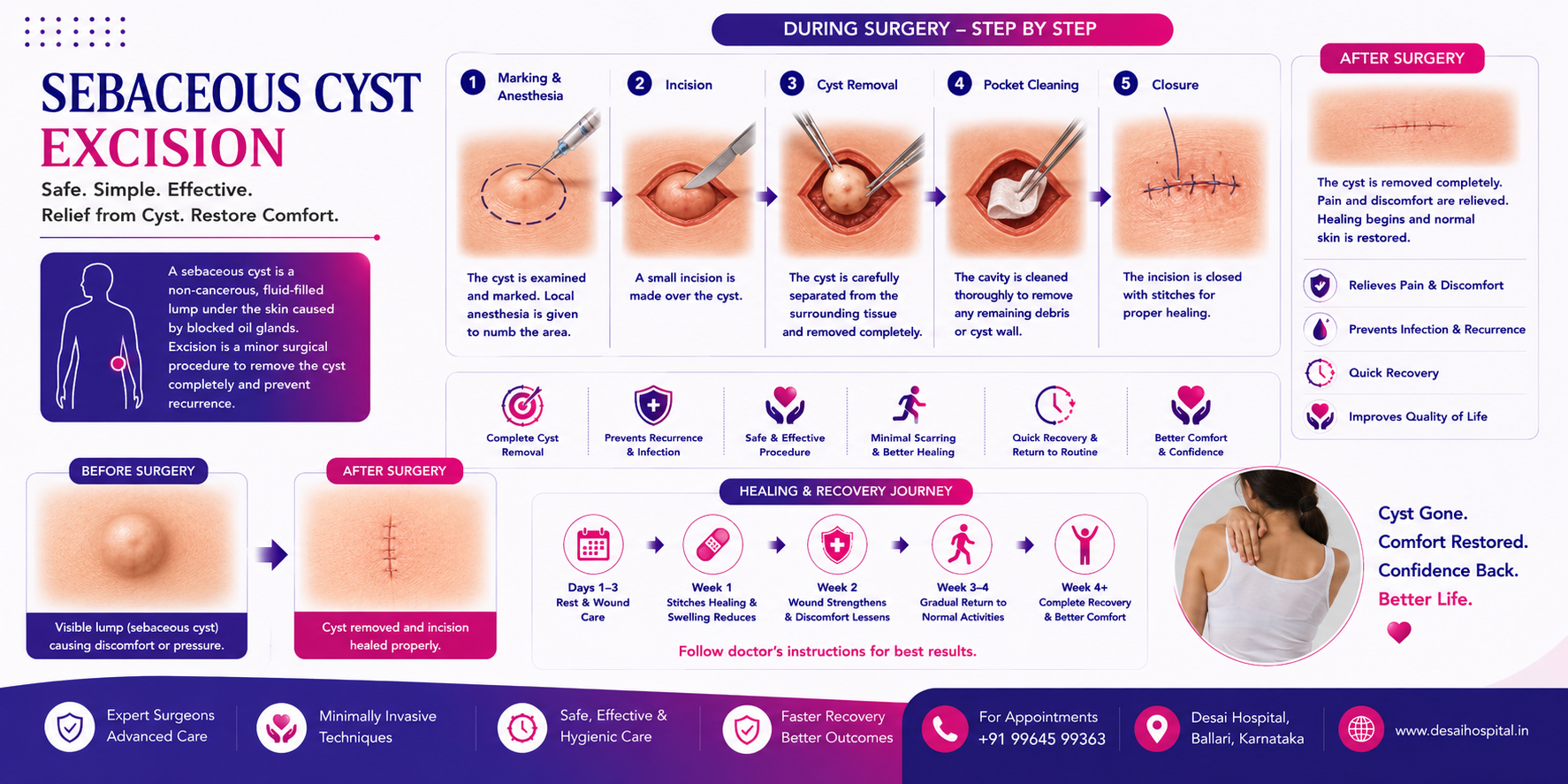 Sebaceous Cyst Excision
