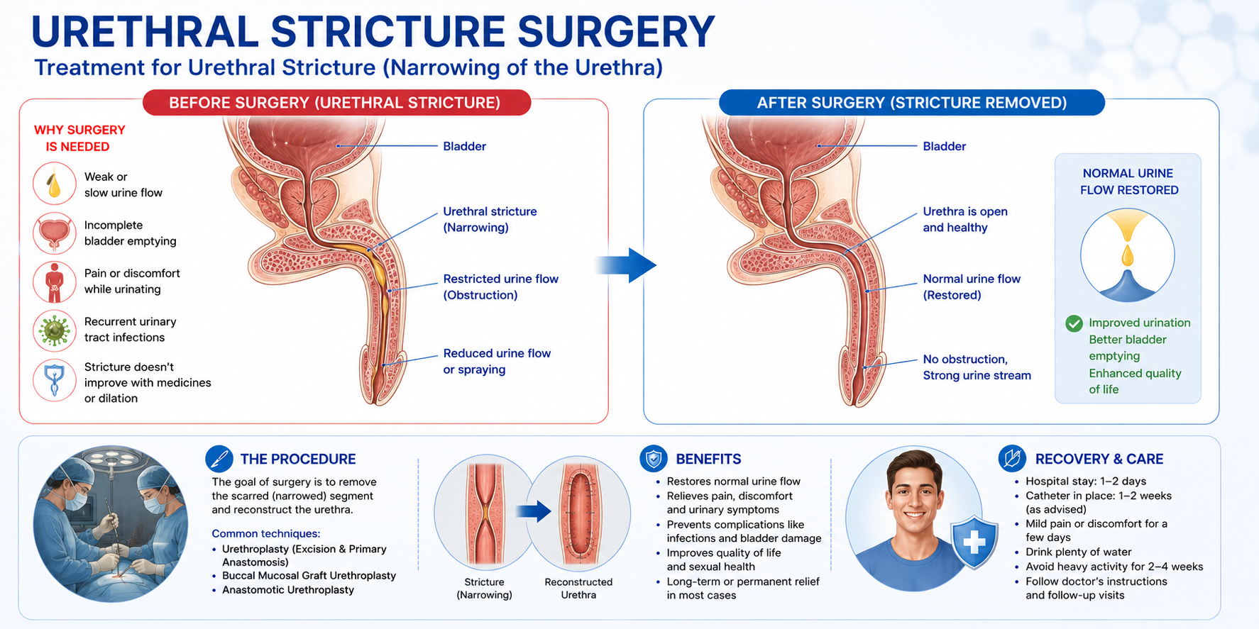 Urethral Stricture Surgery