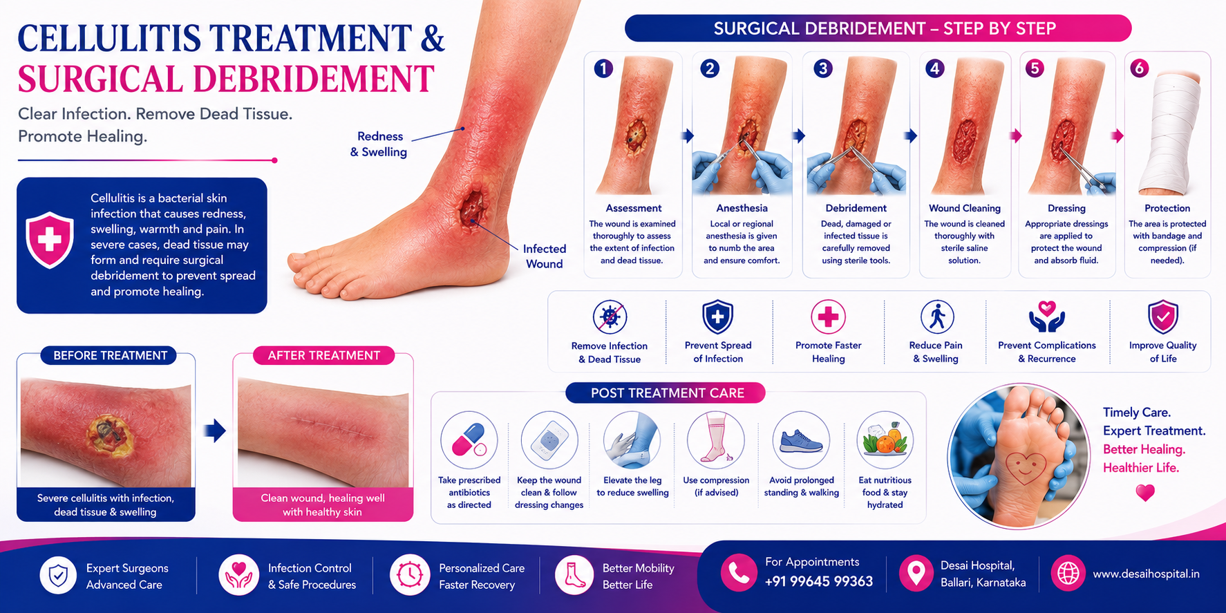 Cellulitis Treatment