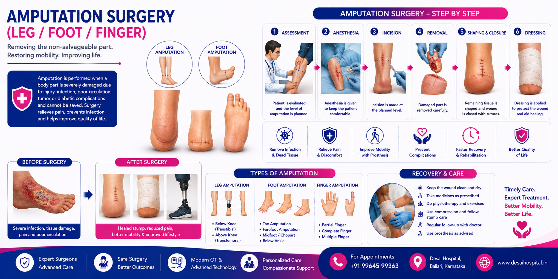 Amputation Surgery